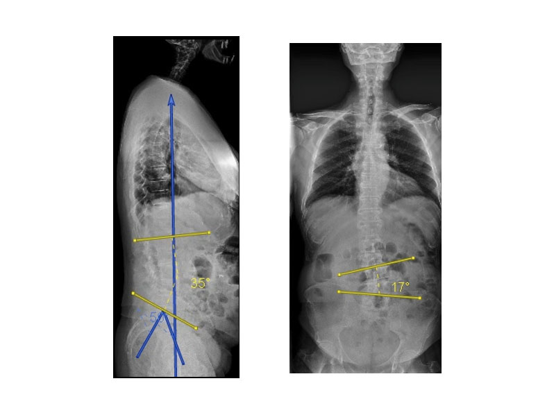 Lumbar Spinal Stenosis  Barrow Neurological Institute