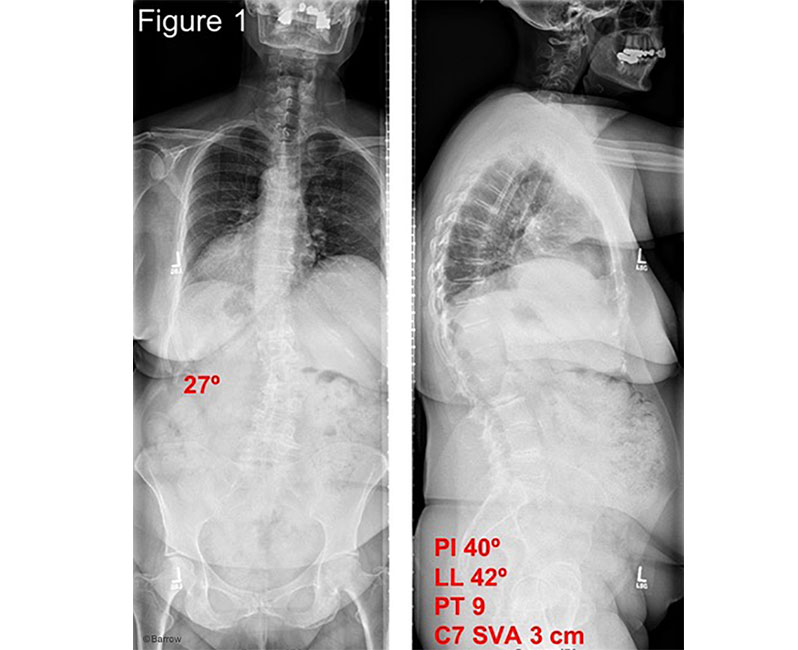 Treatments  iowascoliosis