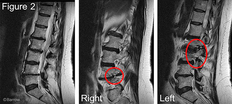 Treatments  iowascoliosis