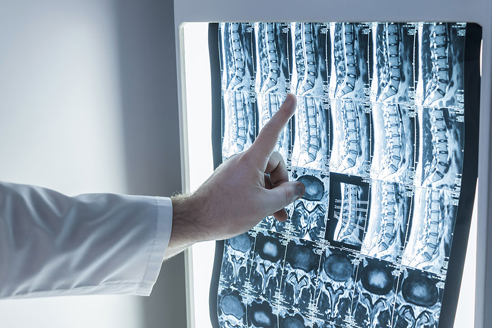 Interbody Fusion: MIS Techniques and Outcomes: Part 2 – TLIF