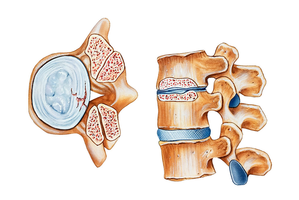 Spinal Stenosis and MIS