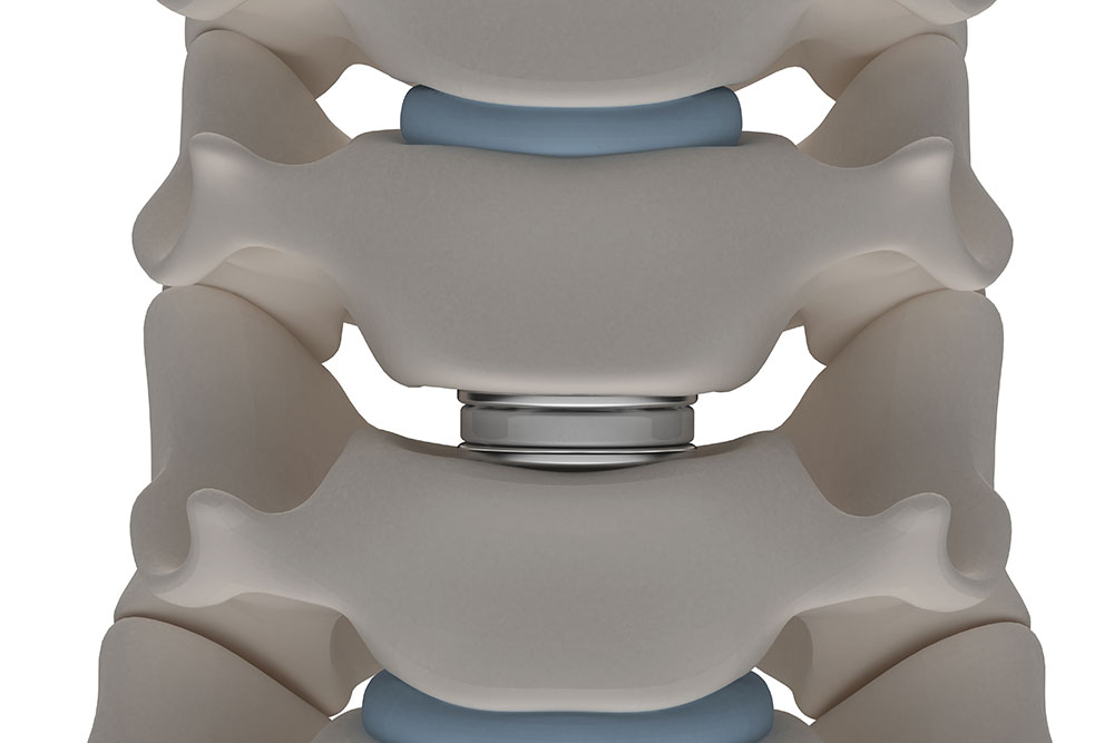 Static vs. Expandable Interbody Devices: Part 2