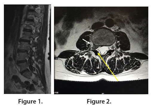 Right L3-L4 Foraminal Lumbar Disc Herniation Approached From the ...